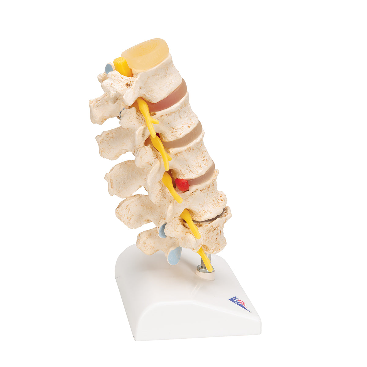 Stages of Disc Prolapse and Vertebral Degeneration - 3B Smart Anatomy