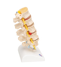 Stages of Disc Prolapse and Vertebral Degeneration - 3B Smart Anatomy