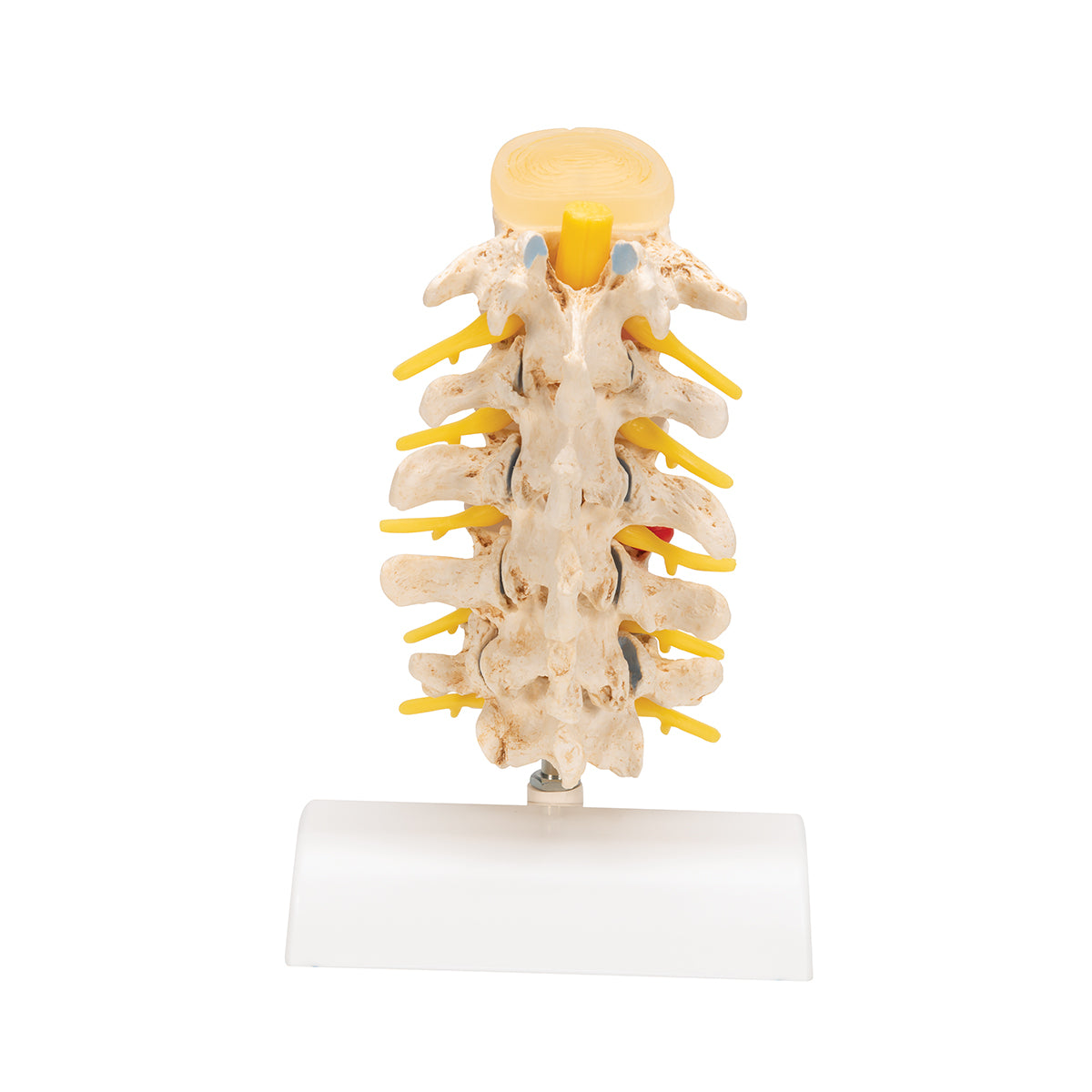 Stages of Disc Prolapse and Vertebral Degeneration - 3B Smart Anatomy