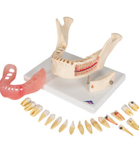 Dental Disease Model, Magnified 2 times, 21 parts - 3B Smart Anatomy