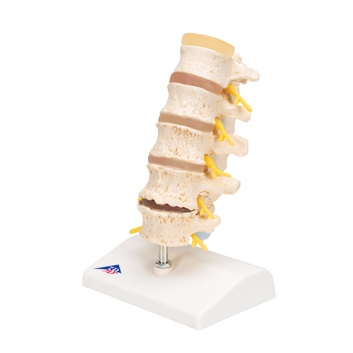 Stages of Disc Prolapse and Vertebral Degeneration - 3B Smart Anatomy