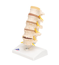 Stages of Disc Prolapse and Vertebral Degeneration - 3B Smart Anatomy