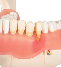 Dental Disease Model, Magnified 2 times, 21 parts - 3B Smart Anatomy