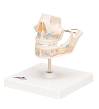 Milk Denture Model with Remaining Teeth - 3B Smart Anatomy