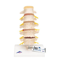 Stages of Disc Prolapse and Vertebral Degeneration - 3B Smart Anatomy