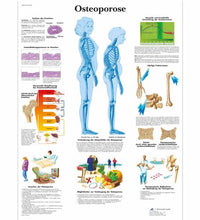 Osteoporose Chart