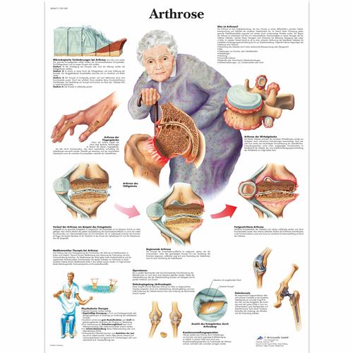 Arthrose