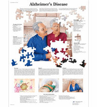 Alzheimer's Disease Chart