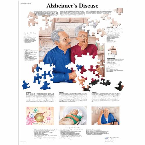 Alzheimer's Disease Chart
