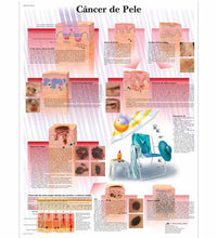 Câncer de Pele