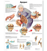 Arthritis Chart