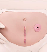 Abdominal Wall with Staple Suture