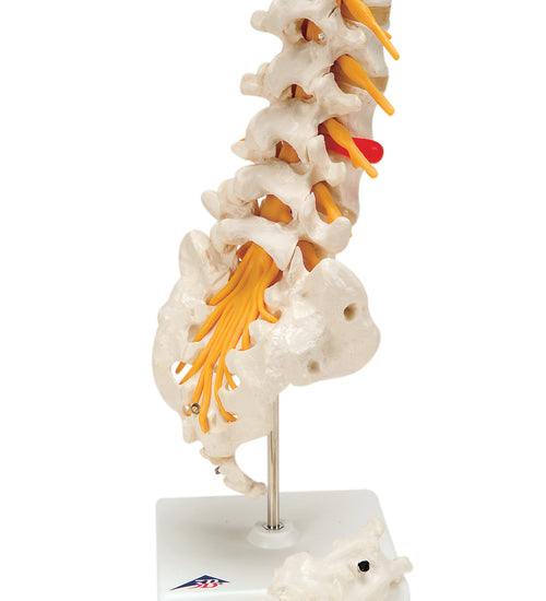 Lumbar spinal column with dorso-lateral prolapsed disc