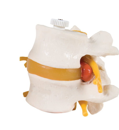 2 Lumbar Vertebrae with prolapsed disc, flexibly mounted